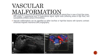  Color Doppler is useful to see the internal vascularity including the arterial flow in case of high flow types.
MRI shows T1 hypointense and T2 hyperintense signal, signal voids (reflecting areas of high flow), and
susceptibility artifacts (areas of thrombosis).
 Vascular malformations can be classified as either low-flow or high-flow lesions with dynamic contrast-
enhanced magnetic resonance (MR) angiography.
 