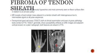 On the US, it appears homogenously hypoechoic and most commonly seen on flexor surface often
in relation to an annular pulley.[
 MR reveals a focal nodular mass adjacent to a tendon sheath with heterogeneous low to
intermediate signal on all pulse sequences
 Tenosynovial giant cell tumor (TSGCT) both at clinical examination and even at gross pathology
looks similar to FTS. TSGCT, generally, show susceptibility artifacts on GRE images and adjacent
cortical erosion on a plain radiograph; both features are absent in FTS.
 
