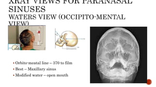  Orbito-meatal line – 370 to film
 Best – Maxillary sinus
 Modified water – open mouth
 