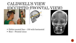  Orbito-meatal line – 150 with horizontal
 Best – Frontal sinus
 