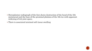  Dorsoplantar radiograph of the foot shows destruction of the head of the 5th
metatarsal and the base of the proximal phalanx of the 5th toe with apparant
widening of teh joint space.
 There is associated minimal soft tissue swelling
 