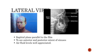  Sagittal plane parallel to the film
 To see anterior and posterior extent of sinuses
 Air fluid levels well appreciated.
 
