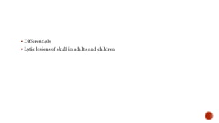  Differentials
 Lytic lesions of skull in adults and children
 