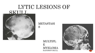 METASTASI
S
MULTIPL
E
MYELOMA
RAINDROP SKULL
 