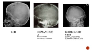 HEMANGIOM
A
HONEYCOMB/
SUNBURST PATTERN
EPIDERMOID
CYST
LOBULATED LYTIC –
SCLEROSED MARGINS
LCH
 