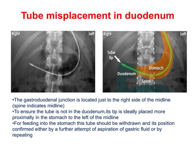 CHEST XRAY TUBES.pptx,,,,,,,,,,,,,,,,,,, | PPTX