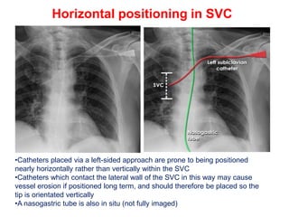 CHEST XRAY TUBES.pptx,,,,,,,,,,,,,,,,,,, | PPTX