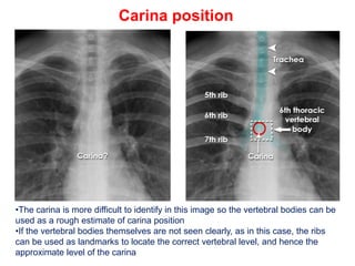 CHEST XRAY TUBES.pptx,,,,,,,,,,,,,,,,,,, | PPTX