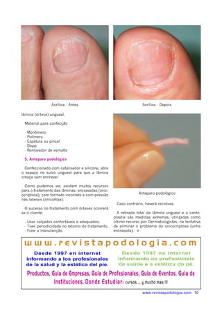 Acrílica - Antes Acrílica - Depois 
lâmina (órtese) ungueal. 
Material para confecção 
- Monômero 
- Polímero 
- Espátula ou pincel 
- Dapp 
- Removedor de esmalte 
5. Anteparo podológico 
Confeccionado com catalisador e silicone, abre 
o espaço no sulco ungueal para que a lâmina 
cresça sem encravar 
Como pudemos ver, existem muitos recursos 
para o tratamento das lâminas: encravadas (onic-ocriptose), 
com formato incorreto e com pressão 
nas laterais (onicofose). 
O sucesso no tratamento com órteses ocorrerá 
se o cliente: 
- Usar calçados confortáveis e adequados. 
- Tiver periodicidade no retorno do tratamento. 
- Fizer a manutenção. 
Anteparo podológico 
Caso contrário, haverá recidivas. 
A retirada total da lâmina ungueal e a canto-plastia 
são medidas extremas, utilizadas como 
último recurso por Dermatologistas, na tentativa 
de eliminar o problema da onicocriptose (unha 
encravada). ¤ 
w w w . r e v i s t a p o d o l o g i a . c o m 
www.revistapodologia.com 10 
Desde 1997 en internet 
informando a los profesionales 
de la salud y la estética del pie. 
Desde 1997 na internet 
informando os profissionais 
da saúde e a estética do pé. 
Productos, Guia de Empresas, Guia de Profesionales, Guia de Eventos, Guia de 
Instituciones, Donde Estudiar: cursos ... y mucho mas !!! 
 
