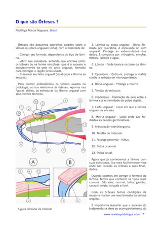 www.revistapodologia.com 7 
O que são Órteses ? 
Podóloga Márcia Nogueira. Brasil. 
Órteses são pequenos aparelhos colados sobre a 
lâmina ou placa ungueal (unha), com a finalidade de: 
- Corrigir seu formato, dependendo do tipo de lâmi-na. 
- Abrir sua curvatura, evitando que encrave (onic-ocriptose) 
ou se forme onicofose, que é o excesso e 
endurecimento da pele no sulco ungueal, formado 
para proteger a região pressionada. 
- Preservar seu leito ungueal (local onde a lâmina se 
encaixa). 
Para melhor entendermos os termos usados na 
podologia, ao nos referirmos às órteses, vejamos nas 
figuras abaixo, as estruturas da lâmina ungueal com 
seus nomes técnicos. 
1. Lâmina ou placa ungueal - Unha, for-mada 
por queratina, é encaixada no leito 
ungueal. Protege as extremidades dos 
dedos. É composta por: nitrogênio, enxofre, 
metais, lipídios e água. 
2. Lúnula - Parte branca na base da lâmi-na. 
3. Eponíquio - Cutícula, protege a matriz 
contra a entrada de microrganismos. 
4. Bolsa ungueal - Protege a matriz. 
5. Tendão do músculo. 
6. Hiponíquio - Formação de pele entre a 
lâmina e a extremidade da polpa digital. 
7. Leito ungueal - Local em que a lâmina 
ungueal se encaixa. 
8. Matriz ungueal - Local onde são for-madas 
as células germinativas. 
9. Articulação interfalangiana. 
10. Tendão do músculo. 
11. Falange proximal - Hálux. 
12. Polpa proximal. 
13. Polpa distal. 
Agora que já conhecemos a lâmina com 
suas estruturas, fica mais fácil entendermos 
onde são coladas as órteses e suas finali-dades. 
Quando falamos em corrigir o formato da 
lâmina, temos que conhecer os tipos mais 
comuns. São eles: normal, telha, gancho, 
caracol, mista, torquês e funil. 
Com as órteses temos condições de 
mudar e manter um novo formato da lâmina 
ungueal. 
É importante ressaltar que o sucesso do 
Figura retirada da Internet tratamento se deve ao acompanhamento do 
 
