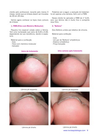 cliente pelo profissional, durante pelo menos 4 
meses, sendo que as órteses devem ser trocadas 
de 20 em 20 dias. 
Vamos agora conhecer os tipos mais comuns 
de órteses 
1. FMM (Fibra com Memória Molecular) 
Pequena tira especial colada sobre a lâmina. 
Tem uma numeração que varia de 0,20 a 0,30, 
dependendo da sua resistência, devido à espes-sura. 
Material para a confecção 
- Cola 
- Fibra com memória molecular 
- Calcador 
Podemos ver a seguir, a evolução do tratamen-to 
em apenas uma semana, feito com a FMM. 
Nesse cliente foi aplicada a FMM de nº 0,25, 
pois sua lâmina não é muito fina e comporta 
essa fibra. 
2. "Bottons" 
Dois Bottons unidos por elástico de silicone. 
Material para confecção 
- Cola 
- Um par de "Bottons" ortodônticos 
- Elástico ortodôntico 
- Pinça trançada 
Uma semana após tratamento 
www.revistapodologia.com 8 
Início do tratamento 
Lâmina pé esquerdo 
Lâmina pé esquerdo 
Lâmina pé direito 
Lâmina pé direito 
 
