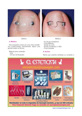Bottons Metálica 
www.revistapodologia.com 9 
3. Metálica 
Dois braquetes unidos por uma mola ortodôn-tica 
confeccionada manualmente. Aplica uma 
grande tração na lâmina. 
Material para confecção 
- Cola 
- Um par de Braquetes 
- Fio de aço ortodôntico 
- Pinça Mathiew 
- Alicate de corte 
- Alicate ortodôntico nº 053 
- Pinça trançada 
4. Acrílica 
Resina que substitui (prótese) ou completa a 
 