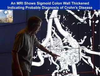 An MRI Shows Sigmoid Colon Wall Thickened
Indicating Probable Diagnosis of Crohn’s Disease
 
