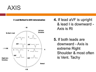 Ecg interpritation | PPTX