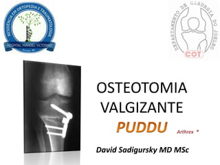 OSTEOTOMIA
VALGIZANTE
Arthrex ®
David Sadigursky MD MSc
 