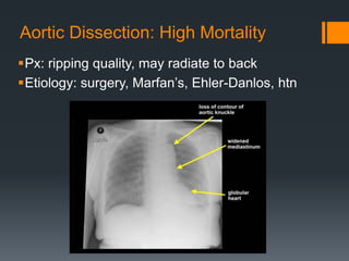 Aortic Dissection: High Mortality
Px: ripping quality, may radiate to back
Etiology: surgery, Marfan’s, Ehler-Danlos, htn
 