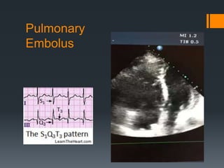 Pulmonary
Embolus
 