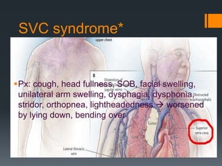 SVC syndrome*
Px: cough, head fullness, SOB, facial swelling,
unilateral arm swelling, dysphagia, dysphonia,
stridor, orthopnea, lightheadedness  worsened
by lying down, bending over
 
