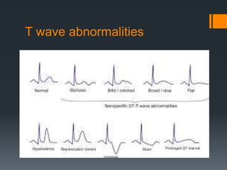 T wave abnormalities
 
