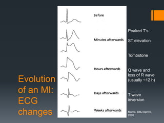 Evolution
of an MI:
ECG
changes
Peaked T’s
ST elevation
Tombstone
Q wave and
loss of R wave
(usually ~12 h)
T wave
inversion
Morris, BMJ April 6,
2002
 