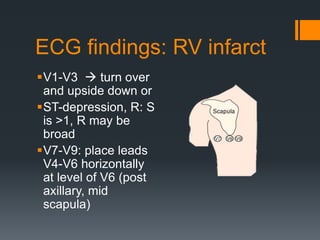 ECG findings: RV infarct
V1-V3  turn over
and upside down or
ST-depression, R: S
is >1, R may be
broad
V7-V9: place leads
V4-V6 horizontally
at level of V6 (post
axillary, mid
scapula)
 