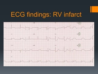 ECG findings: RV infarct
 