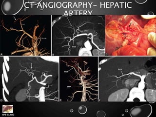 HPB CLINIC
CT ANGIOGRAPHY- HEPATIC
ARTERY
 