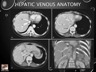 HPB CLINIC
HEPATIC VENOUS ANATOMY
 