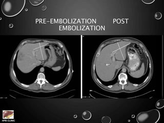 HPB CLINIC
PRE-EMBOLIZATION POST
EMBOLIZATION
 