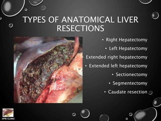 HPB CLINIC
TYPES OF ANATOMICAL LIVER
RESECTIONS
• Right Hepatectomy
• Left Hepatectomy
• Extended right hepatectomy
• Extended left hepatectomy
• Sectionectomy
• Segmentectomy
• Caudate resection
 