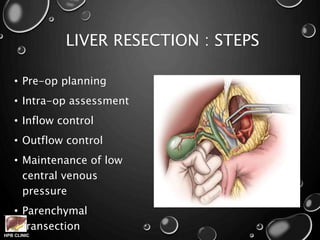 HPB CLINIC
LIVER RESECTION : STEPS
• Pre-op planning
• Intra-op assessment
• Inflow control
• Outflow control
• Maintenance of low
central venous
pressure
• Parenchymal
transection
 