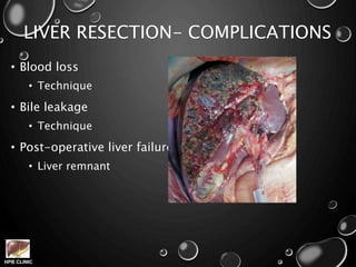 HPB CLINIC
LIVER RESECTION- COMPLICATIONS
• Blood loss
• Technique
• Bile leakage
• Technique
• Post-operative liver failure
• Liver remnant
 