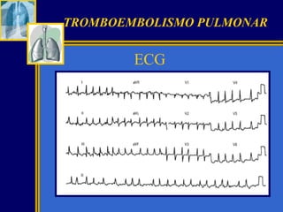 TROMBOEMBOLISMO PULMONAR

ECG

 