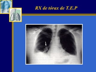 RX de tórax de T.E.P

 