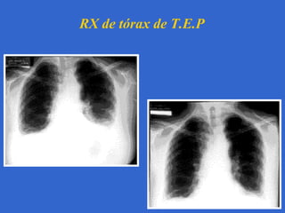 RX de tórax de T.E.P

 