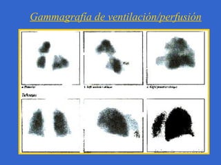 Gammagrafía de ventilación/perfusión

 