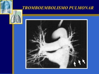 TROMBOEMBOLISMO PULMONAR

 