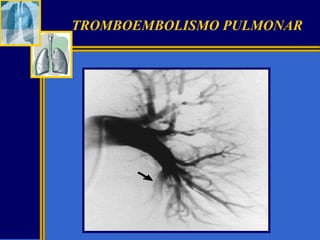 TROMBOEMBOLISMO PULMONAR

 