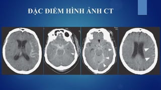 ĐẶC ĐIỂM HÌNH ẢNH CT
 