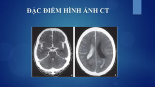 ĐẶC ĐIỂM HÌNH ẢNH CT
 