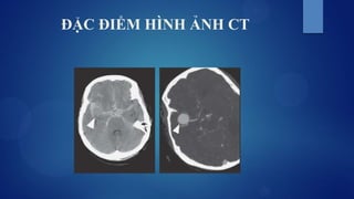 ĐẶC ĐIỂM HÌNH ẢNH CT
 