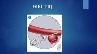 ĐIỀU TRỊ
 