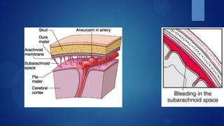 Xuất Huyết Khoang Dưới Nhện