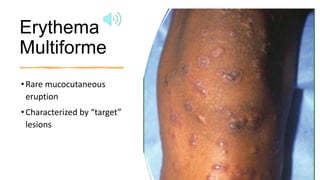 Urticaria Multiform Rash Dermatology Urticaria, Agioedema, Erythema Multiforme.pdf