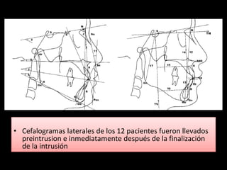 • Cefalogramas laterales de los 12 pacientes fueron llevados
  preintrusion e inmediatamente después de la finalización
  de la intrusión
 