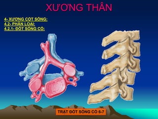 XƯƠNG THÂN
4- XƯƠNG CỘT SỐNG:
4.2- PHÂN LOẠI:
4.2.1- ĐỐT SỐNG CỔ:
TRẬT ĐỐT SỐNG CỔ 6-7
 