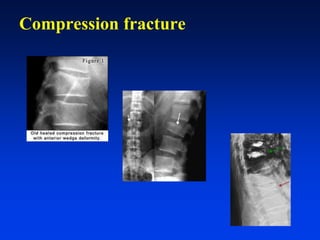Cst Compression Injury CHẤN THƯƠNG CỘT SỐNG | PDF