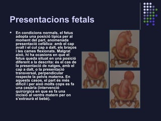 Presentacions fetals <ul><li>En condicions normals, el fetus adopta una posició típica per al moment del part, anomenada p...
