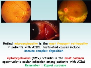 Retinal microangiopathy is the most frequent retinopathy
in patients with AIDS. Postulated causes include
immune complex deposition
Cytomegalovirus (CMV) retinitis is the most common
opportunistic ocular infection among patients with AIDS
Remember : Kaposi sarcoma
 