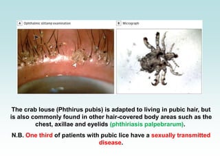 The crab louse (Phthirus pubis) is adapted to living in pubic hair, but
is also commonly found in other hair-covered body areas such as the
chest, axillae and eyelids (phthiriasis palpebrarum).
N.B. One third of patients with pubic lice have a sexually transmitted
disease.
 